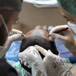 hair transplant, treatment, surgery