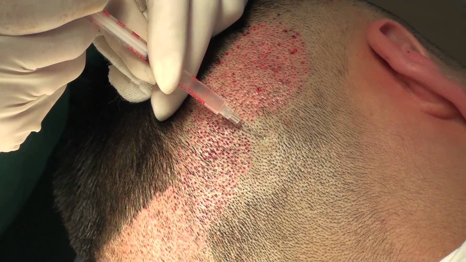 Hair Transplant