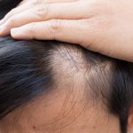 signs of alopecia