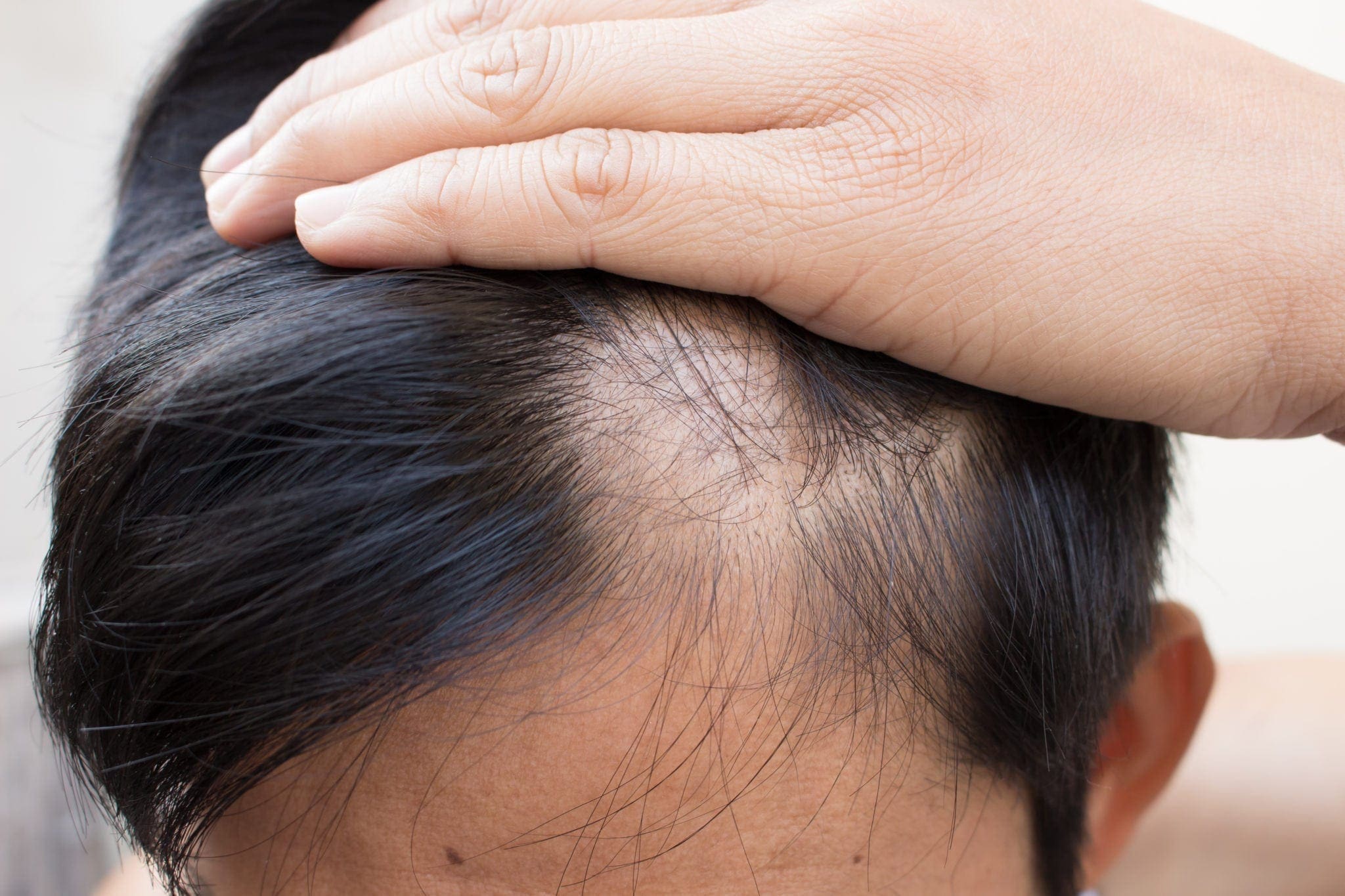 signs of alopecia