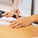 Crop anonymous male doctor putting needles on back during acupuncture therapy session in rehabilitation salon