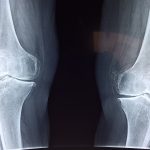 knee, x-ray, medical