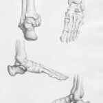 Medical diagram showing leg-lengthening surgery technique on femur bone